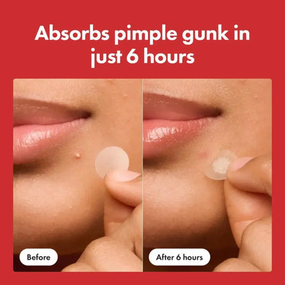 Mighty Patch Hydrocolloid Spot Treatment